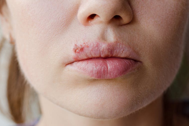Woman with a cold sore on her upper lip.